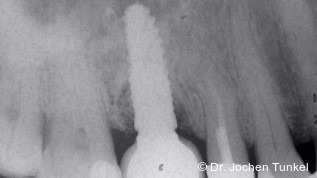 Periimplantäre Knochenregeneration mit Implantat- und Prothetikerhalt