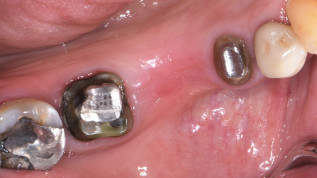 Microveneering von Zirkondioxid