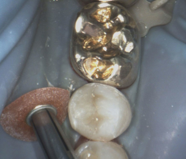 Austausch eines Goldinlays – ZWP online – das Nachrichtenportal für die Dentalbranche