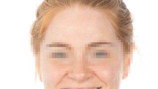 Ausgeprägter erosiver Zahnverschleiß: Ein substanzschonender Ansatz