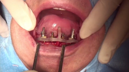 Video der Live-OP: &bdquo;Das COMFOUR&reg; Konzept &ndash; Teil 1&ldquo;