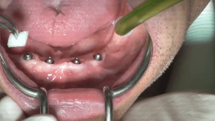 Video der Live-OP: &bdquo;Das COMFOUR&reg; Konzept &ndash; Teil 2&ldquo;