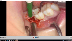 Video der Live-OP: Das SDS ALL-IN-ONE-CONCEPT &ndash; Teil 2