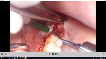 Video der Live-OP: Das SDS ALL-IN-ONE-CONCEPT &ndash; Teil 3