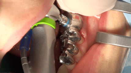 Video der Live-OP: Digitaler Workflow in der Implantologie und Prothetik
