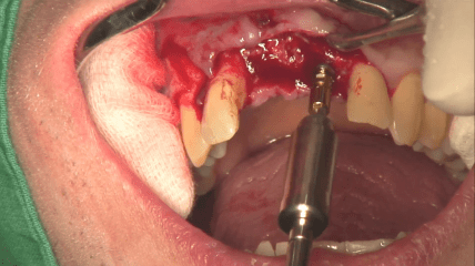 Video der CAMLOG Live-OP: Komplett augmentierter Bereich