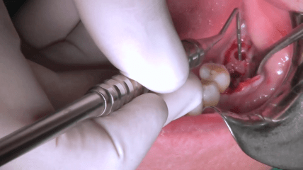 Video der Live-OP: Versorgung einer unilateralen Freiendsituation mit CONELOG