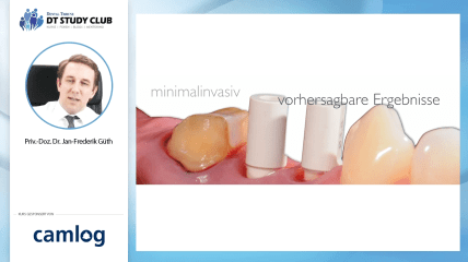 Webinar des Monats: Das M&uuml;nchener Implantatkonzept im digitalen Workflow