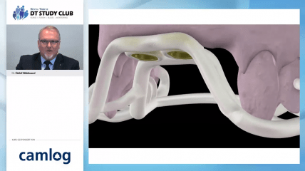 Webinar des Monats: Die Sofortversorgung mit COMFOUR&trade;